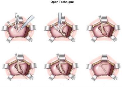 Extravesical Ureteral Reimplantation Following Lich-Gregoir Technique for the Correction of Vesico-Ureteral Reflux Retrospective Comparative Study Open vs. Laparoscopy